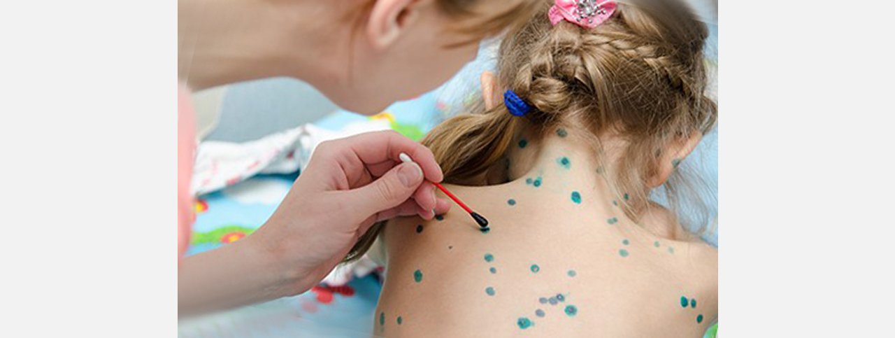 В Челябинской области зафиксирован рост заболеваемости ветряной оспой 